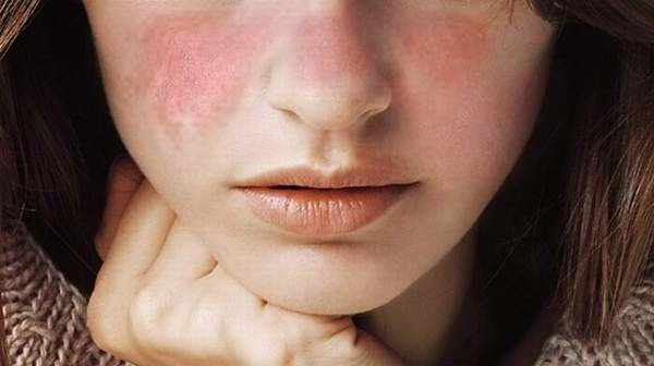Systemic Lupus Erythematosus - Causes, Symptoms and Treatment - Earth's
