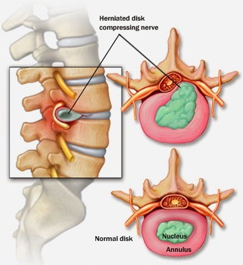 Slipped Disc – Causes Symptoms, Measures and Treatment – Earth's Lab