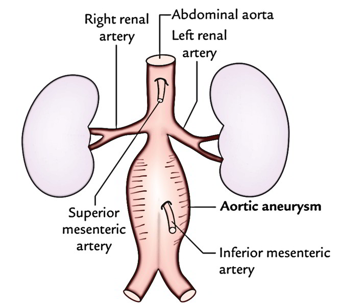 Easy Notes On Abdominal Aorta Learn In Just 3 Minutes