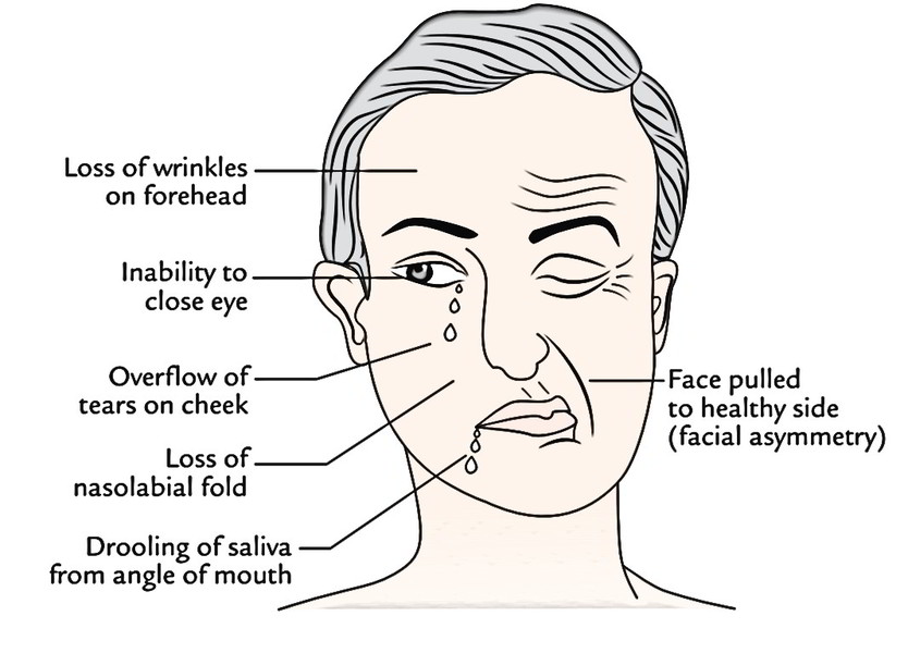 Face Anatomy: Face deformation