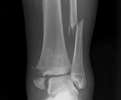 Fibular Fracture