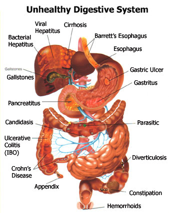 Disorders of The Digestive System – Earth's Lab