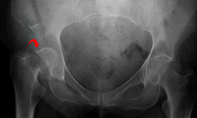 Hip Bone Fracture