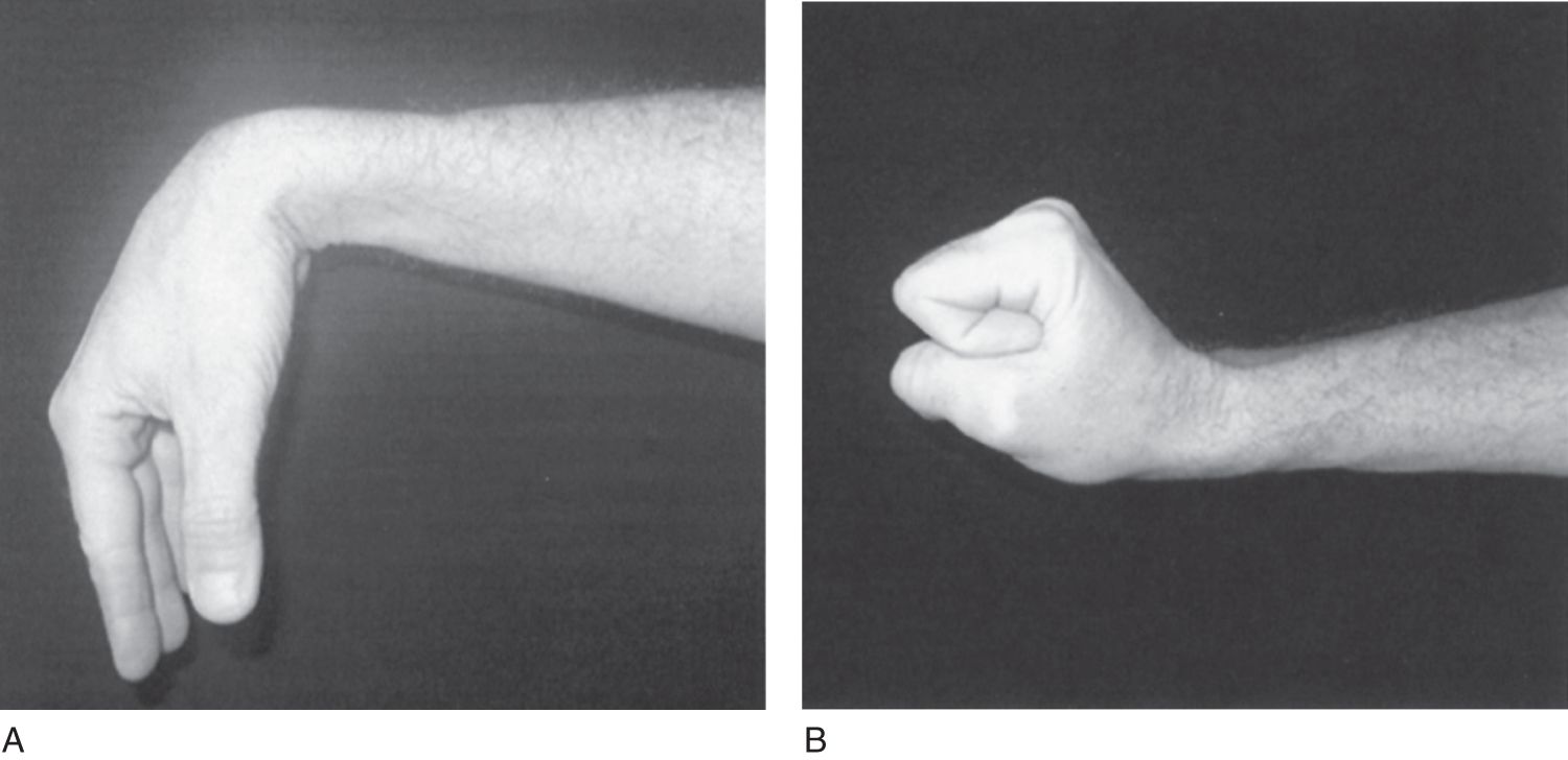  Wrist-drop: a result of radial nerve palsy