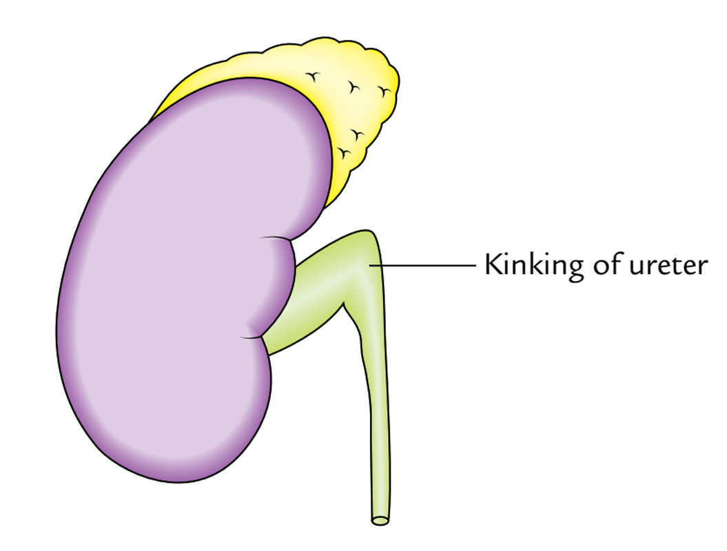 Kidneys: Perirenal Fat