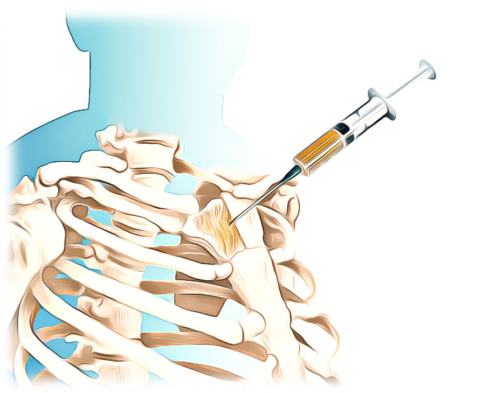 Sternum - Sternal Puncture