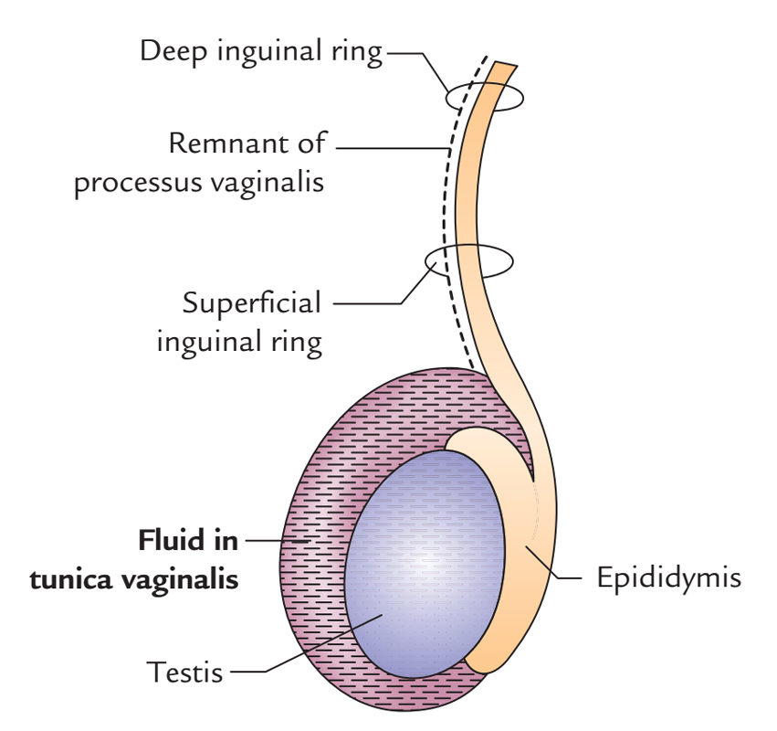 Testis and Epididymis: Hydrocele