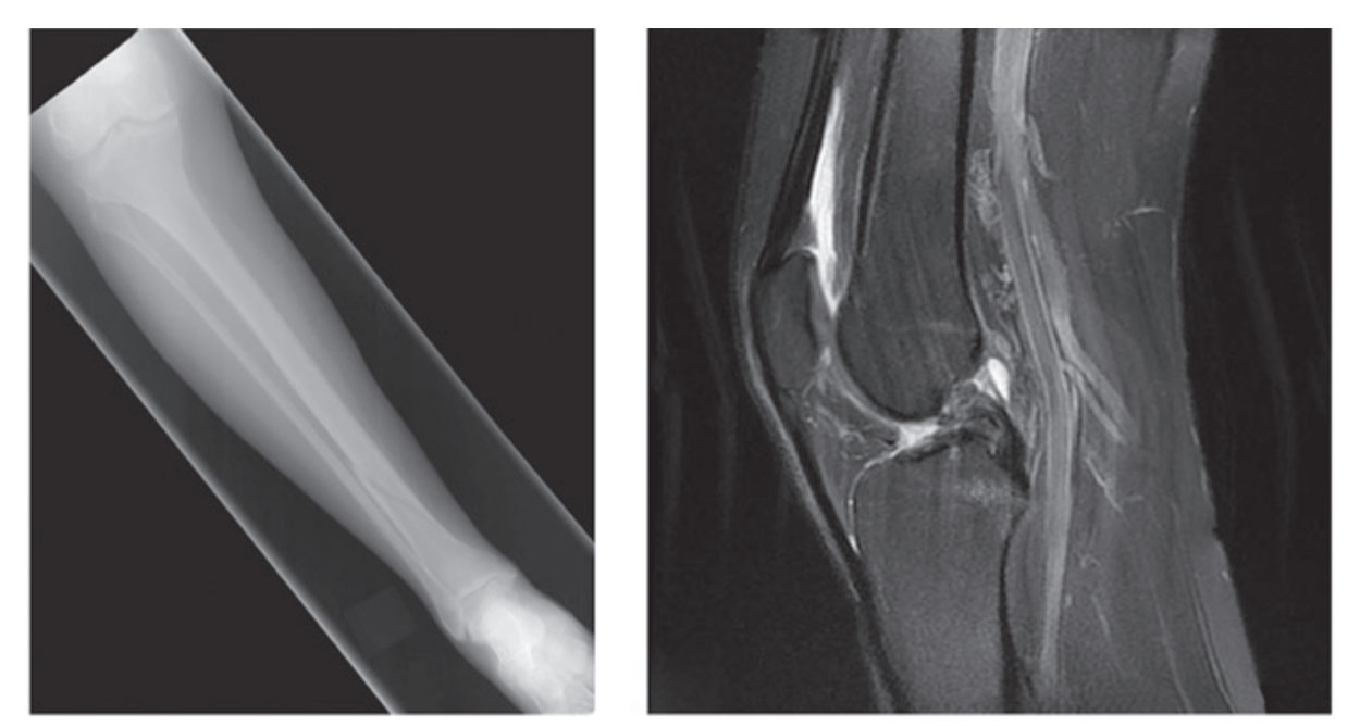 Fractured Tibia 