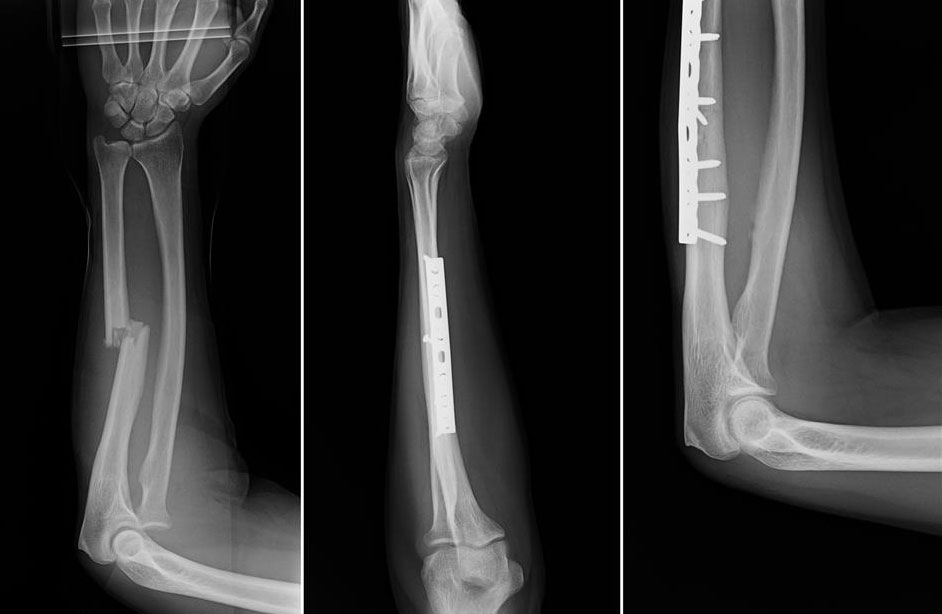 Fractured Ulna