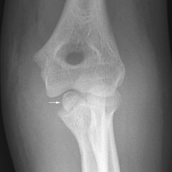 Epicondyle Fracture