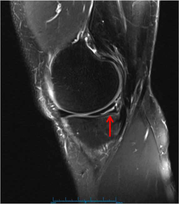 Medial Meniscus Tear 