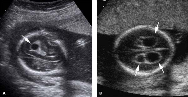 CHOROID PLEXUS CYSTS