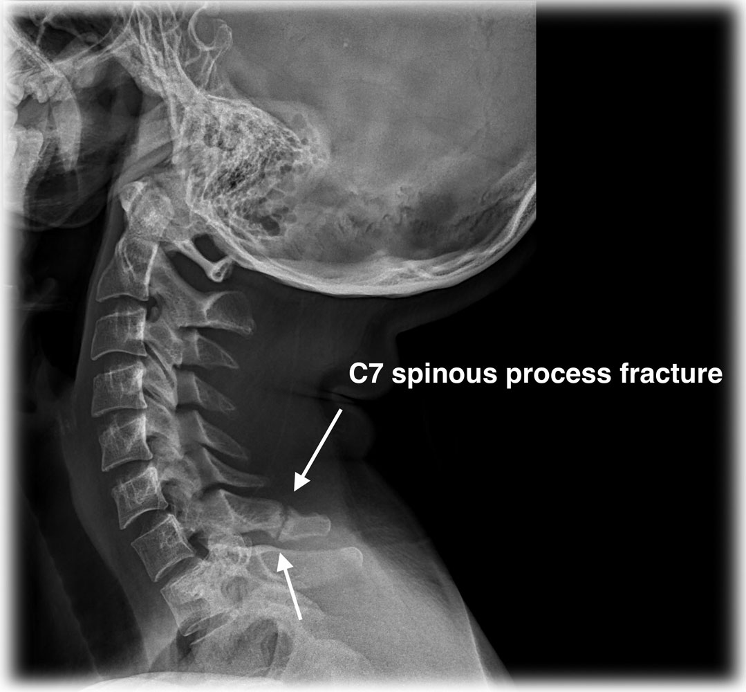 Clay-shoveler’s Fracture