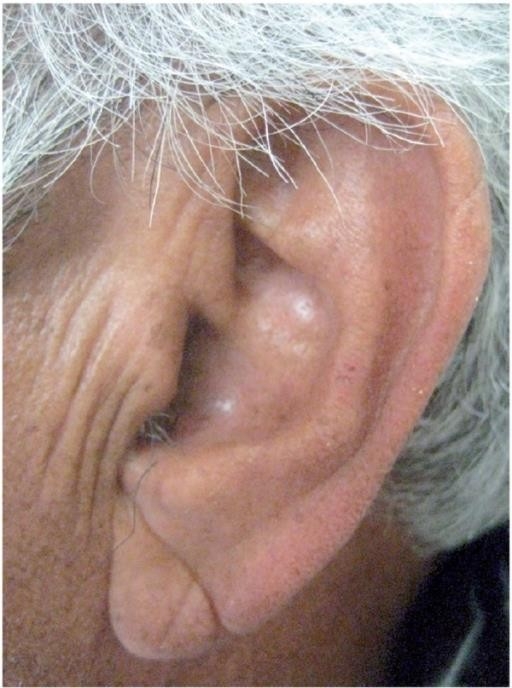 Lobule of Ear - Frank's Sign