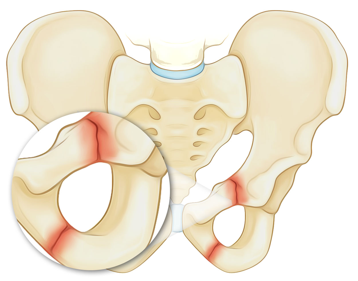 Pubic Ramus Fractures 