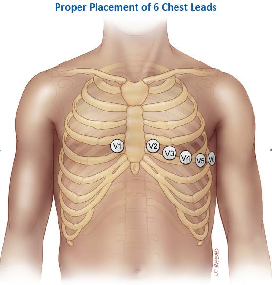 Chest lead placements on anterior axillary line