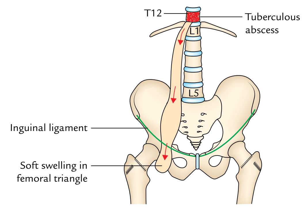 Psoas Major: Psoas Abscess